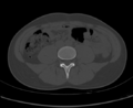 Aneurysmal bone cyst of ischium (Radiopaedia 25957-26094 Axial bone window 3).png