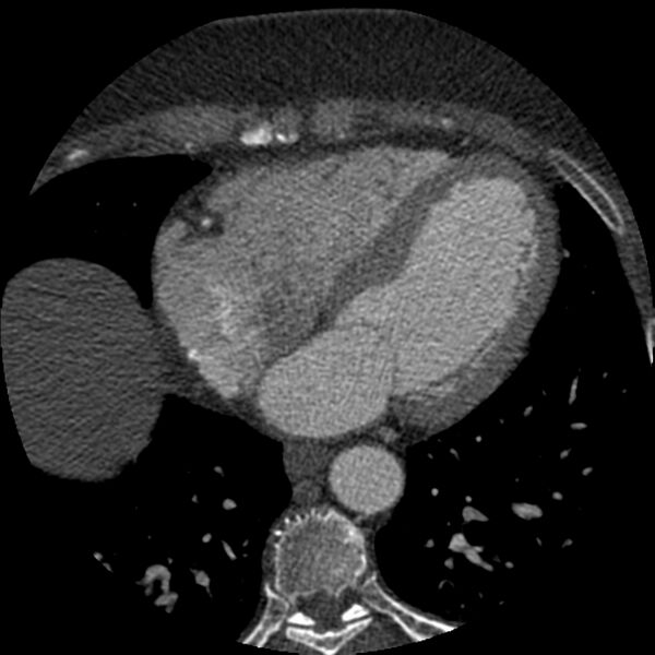 File:Anomalous origin of left circumflex artery from right coronary sinus (Radiopaedia 72563-83117 B 105).jpg