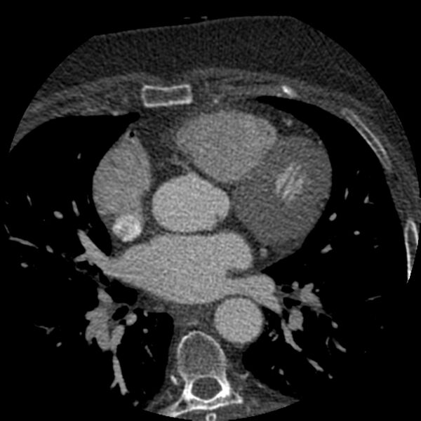 File:Anomalous origin of left circumflex artery from right coronary sinus (Radiopaedia 72563-83117 B 54).jpg
