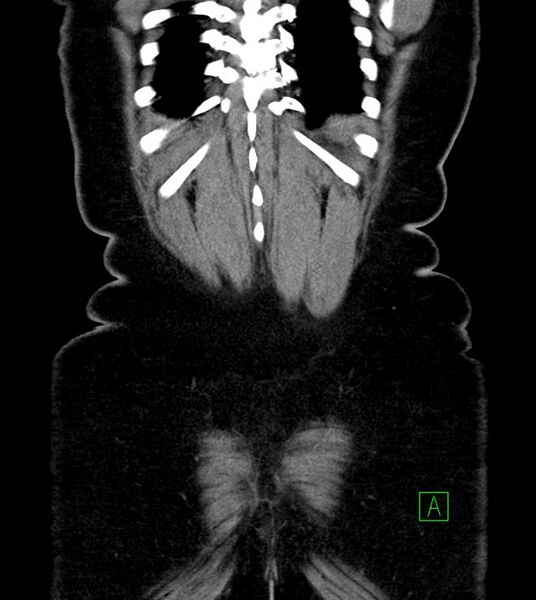 File:Anterior abdominal wall CSF pseudocyst (CSFoma) (Radiopaedia 79453-92571 B 50).jpg