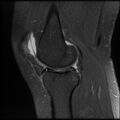 Anterior cruciate ligament tear, Wrisberg rip and bucket-handle tear of medial meniscus (Radiopaedia 75872-87266 Sagittal PD fat sat 17).jpg