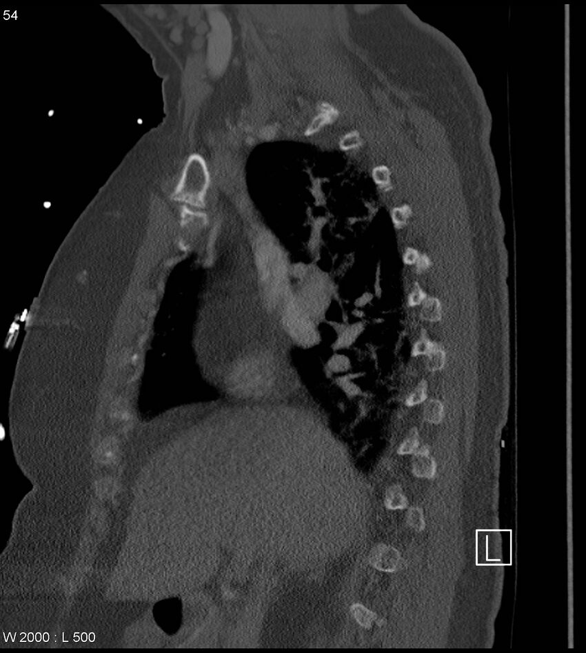 Anterior shoulder dislocation (CT) (Radiopaedia 59032-66309 Sagittal bone window 27).jpg