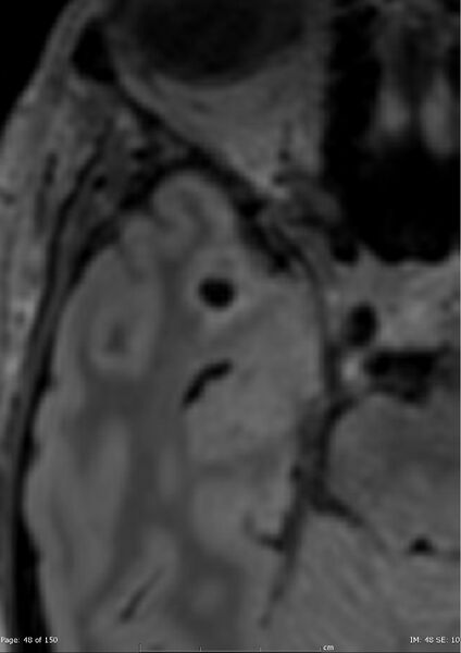 File:Anterior temporal lobe perivascular space (Radiopaedia 40946-43650 C 9).jpg