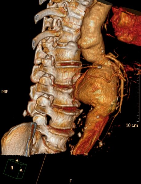 File:Anterior vertebral scalloping (abdominal aortic aneurysm) (Radiopaedia 66744-76067 B 4).jpg
