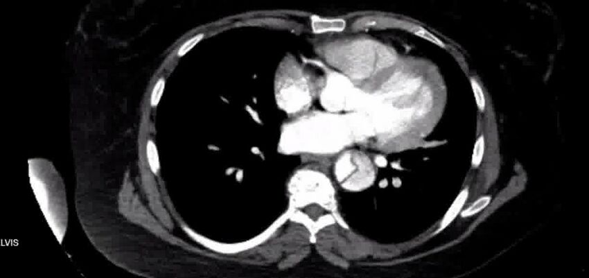 Aortic Dissection (Radiopaedia 85272-100847 A 28).jpg