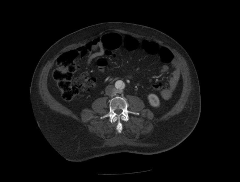 File:Aortic dissection (Radiopaedia 28802-29105 A 69).jpg