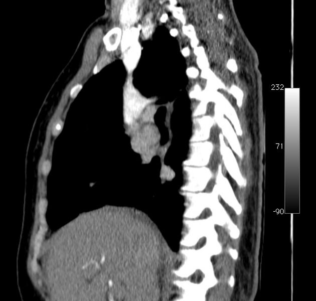 File:Aortic dissection - Stanford type A (Radiopaedia 29247-29659 C 37).jpg
