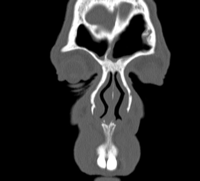 File:Aplastic maxillary sinuses (Radiopaedia 60030-67561 Coronal non-contrast 6).jpg