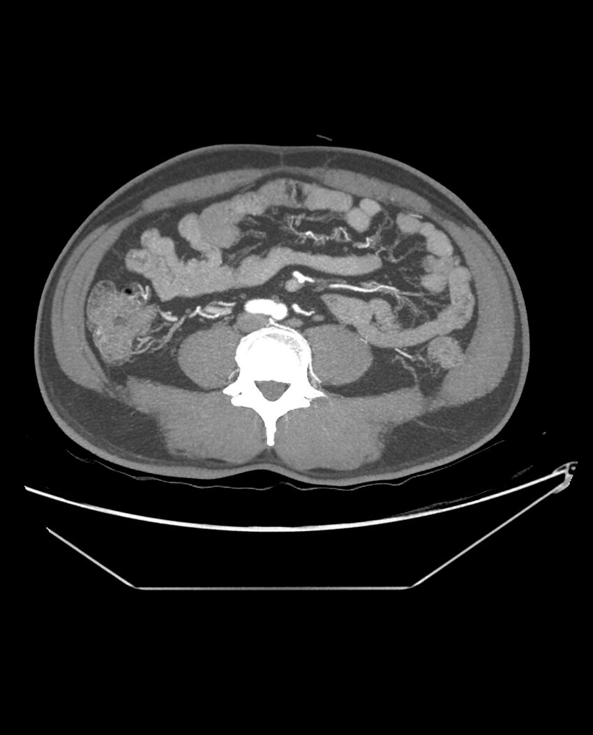 Aplastic posterior tibial arteries (Radiopaedia 84021-99249 A 68).jpg