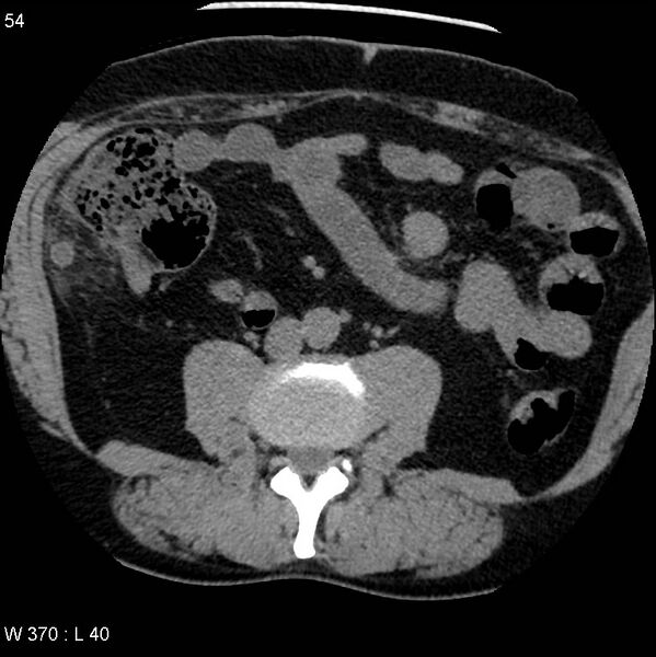 File:Appendicitis (Radiopaedia 12510-12733 Axial non-contrast 21).jpg