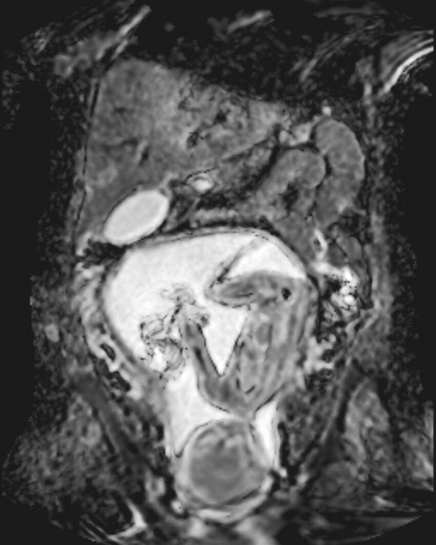 Appendicitis in gravida (MRI) (Radiopaedia 89433-106395 Coronal ADC 25).jpg