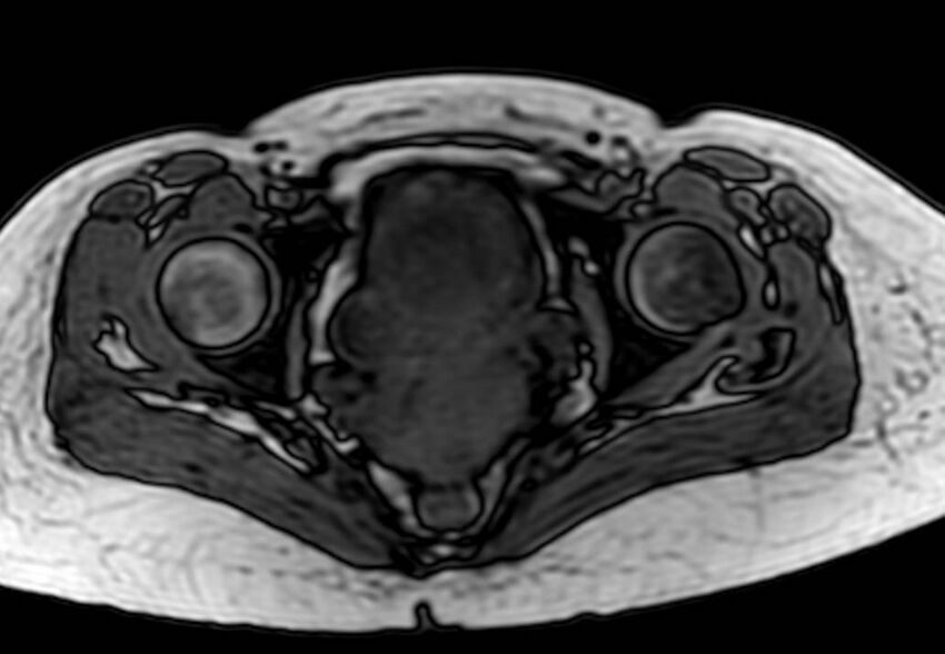 Appendicitis in gravida (MRI) (Radiopaedia 89433-106395 D 66).jpg
