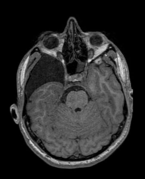 File:Arachnoid cyst- extremely large (Radiopaedia 68741-78451 Axial T1 25).jpg