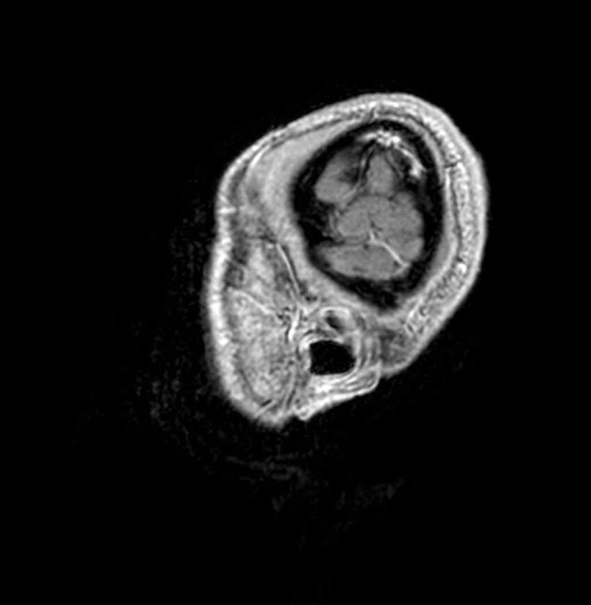 Arachnoid cyst- extremely large (Radiopaedia 68741-78451 Sagittal T1 C+ 5).jpg