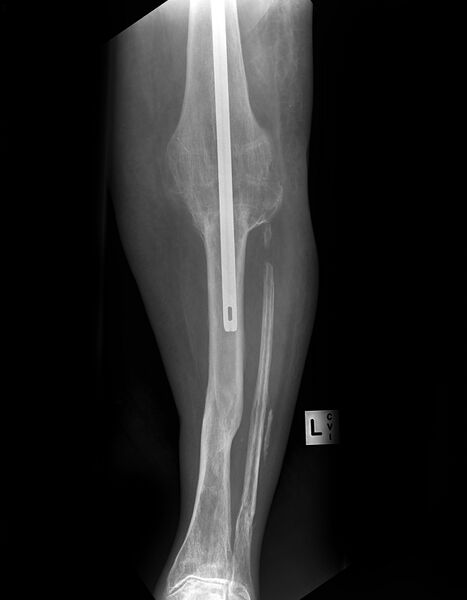 File:Arthrodesis - knee (Radiopaedia 17808).jpg