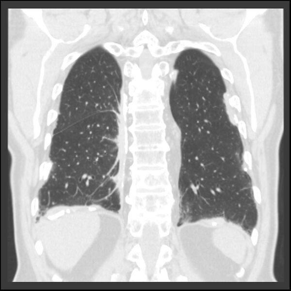 File:Asbestos-related pleural plaques (Radiopaedia 39069-41255 Coronal lung window 19).jpg