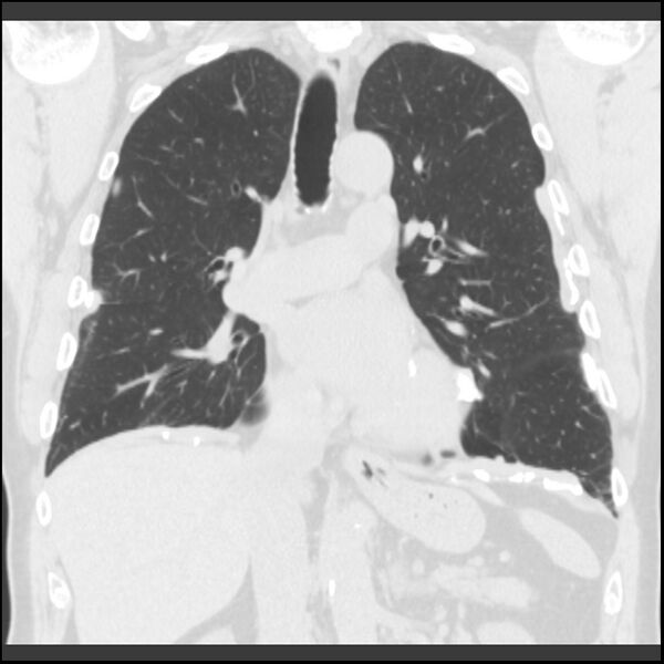 File:Asbestos-related pleural plaques (Radiopaedia 39069-41255 Coronal lung window 47).jpg