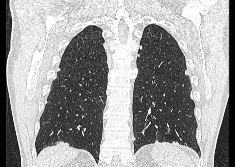 File:Asbestos pleural placques (Radiopaedia 57905-64872 Coronal lung window 229).jpg