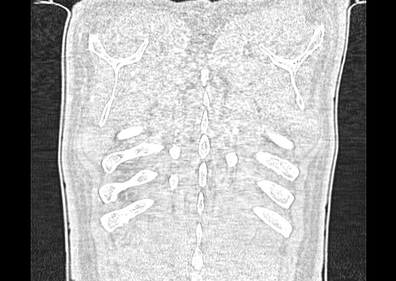 File:Asbestos pleural placques (Radiopaedia 57905-64872 Coronal lung window 284).jpg