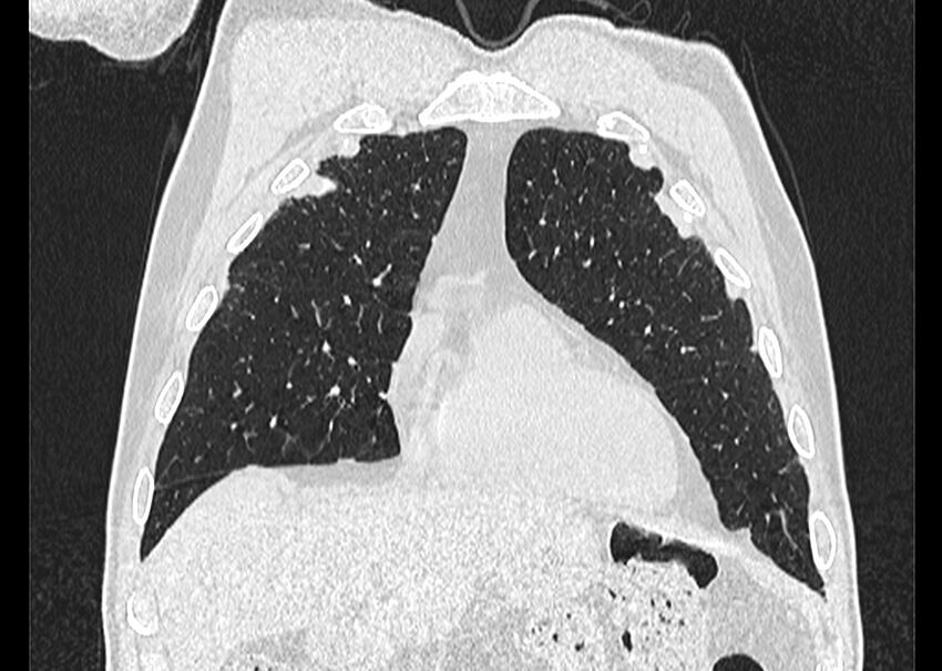 Asbestos pleural placques (Radiopaedia 57905-64872 Coronal lung window 62).jpg