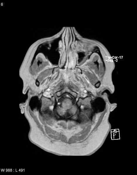 File:Astroblastoma (Radiopaedia 39792-42217 Axial T1 C+ 5).jpg