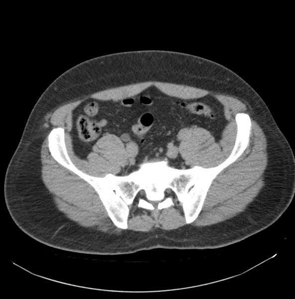 File:Atrophic kidney due to severe chronic obstructive hydronephrosis (Radiopaedia 40828-43474 Axial non-contrast 31).jpg