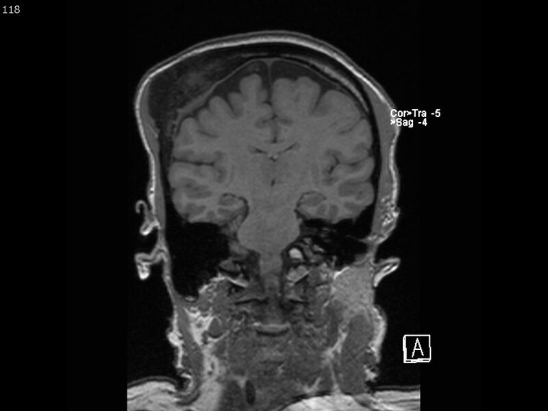 File:Atypical meningioma - intraosseous (Radiopaedia 64915-74572 Coronal T1 118).jpg