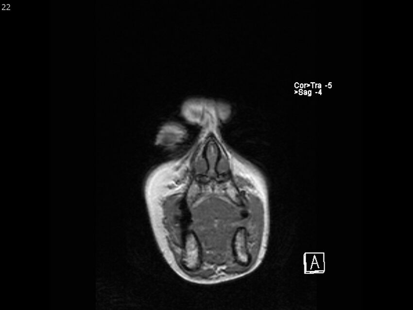 Atypical meningioma - intraosseous (Radiopaedia 64915-74572 Coronal T1 22).jpg