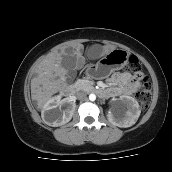 File:Autosomal dominant polycystic kidney disease (Radiopaedia 23061-23093 B 28).jpg
