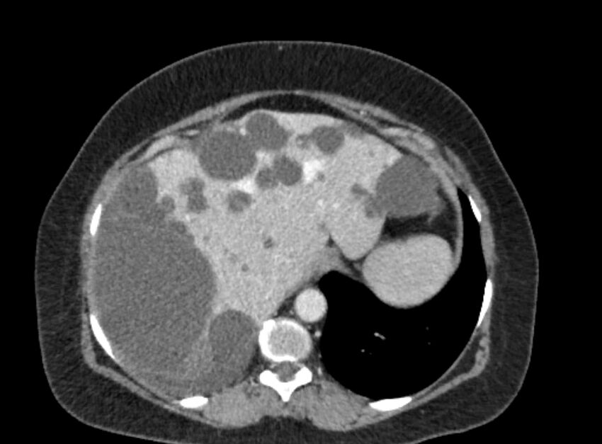 Autosomal dominant polycystic kidney disease (Radiopaedia 57124-64017 A 26).jpg