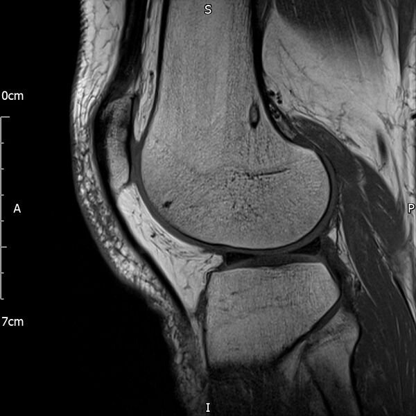 File:Avulsion fracture of the fibular head (Radiopaedia 74804-85808 D 24).jpg