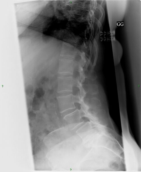 File:Baastrup syndrome (Radiopaedia 48508-53456 Lateral 1).jpg
