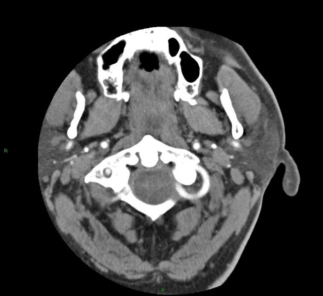 File:Basal ganglia hemorrhage (Radiopaedia 58763-65985 D 2).jpg