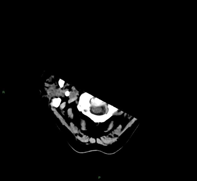 File:Basal ganglia hemorrhage (Radiopaedia 58775-66008 Axial non-contrast 55).jpg