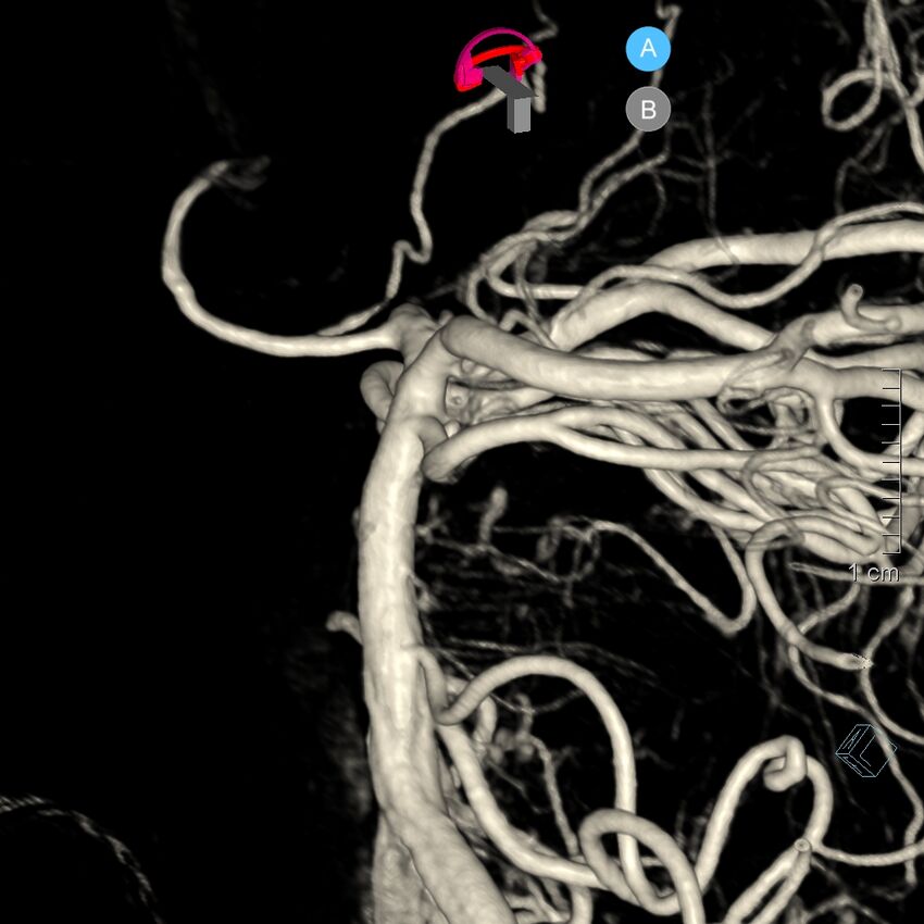 Basilar artery perforator aneurysm (Radiopaedia 82455-97734 3D view left VA 97).jpg