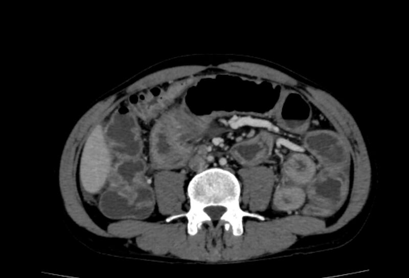 File:Behçet's disease- abdominal vasculitis (Radiopaedia 55955-62570 A 45).jpg