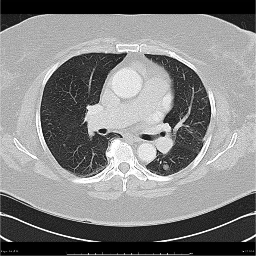 Benign metastasizing leiomyoma (Radiopaedia 26803-26962 Axial lung window 24).jpg