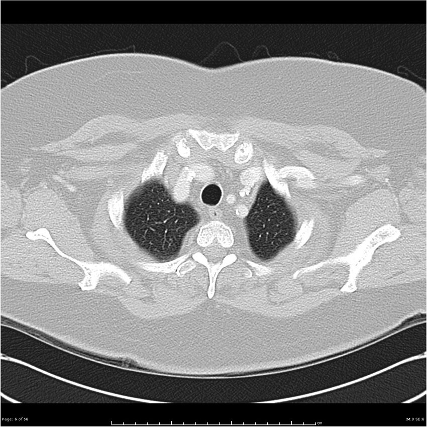 Benign metastasizing leiomyoma (Radiopaedia 26803-26962 Axial lung window 6).jpg