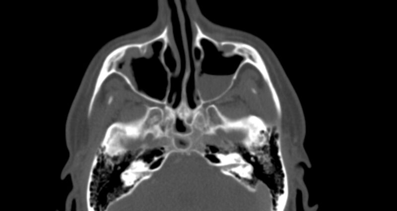 File:Benign mixed salivary tumor of the parotid gland (Radiopaedia 35261-36792 Axial bone window 7).jpg