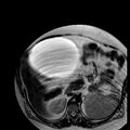 Benign seromucinous cystadenoma of the ovary (Radiopaedia 71065-81300 B 34).jpg