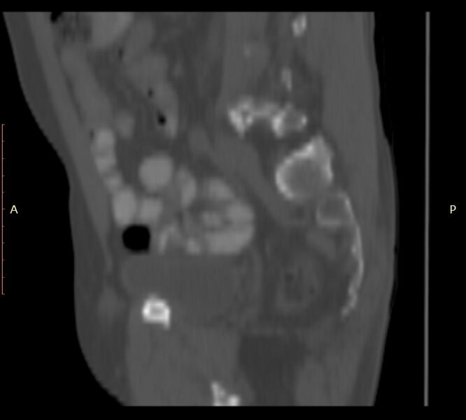 File:Bertolotti syndrome (Radiopaedia 58974-66235 Sagittal bone window 10).jpg