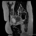 Bicornuate uterus- on MRI (Radiopaedia 49206-54297 Sagittal T2 22).jpg