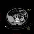 Bifid ureter (Radiopaedia 47604-52253 Axial C+ delayed 8).jpg