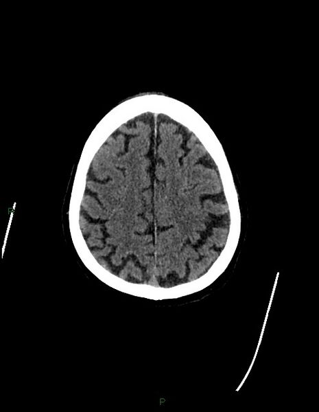 File:Bilateral acute middle cerebral artery territory infarcts (Radiopaedia 77319-89401 Axial non-contrast 70).jpg