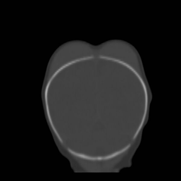 File:Bilateral cephalohematomas and subdural hematomas (Radiopaedia 26778-26929 Coronal bone window 1).jpg