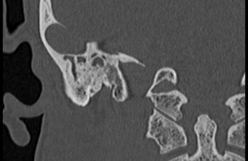 File:Bilateral cholesteatoma (Radiopaedia 54898-61172 Coronal bone window 68).jpg