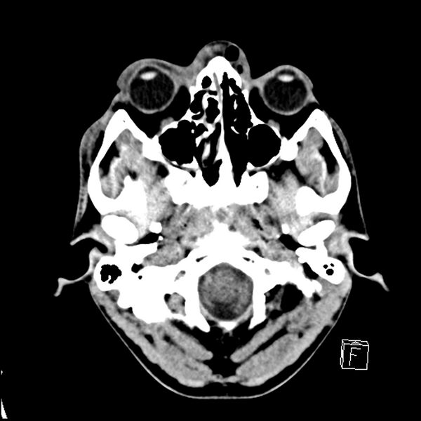 File:Bilateral choroid plexus xanthogranulomata (Radiopaedia 73303).jpg