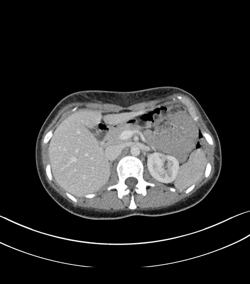 Bilateral kidney malrotation (Radiopaedia 72227-82749 A 9).jpg