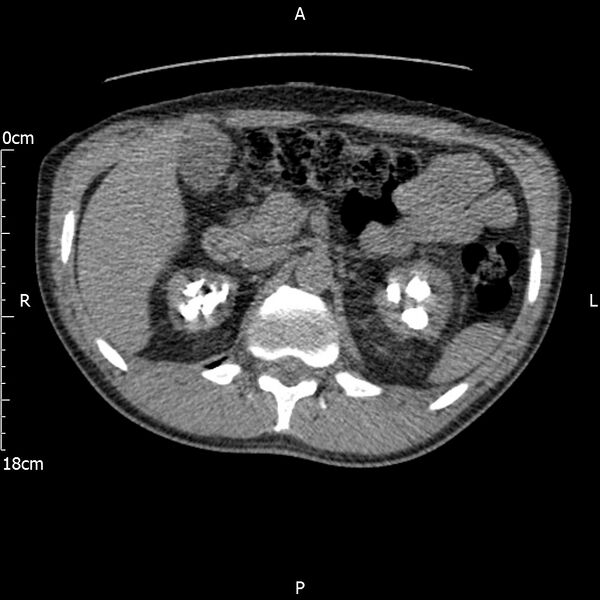 File:Bilateral medullary nephrocalcinosis with ureteric calculi (Radiopaedia 71269-81569 Axial non-contrast 34).jpg