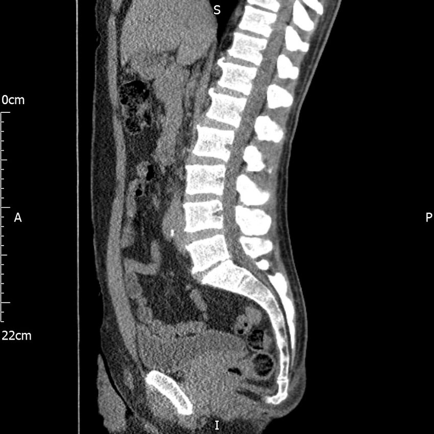 Bilateral medullary nephrocalcinosis with ureteric calculi (Radiopaedia 71269-81569 C 62).jpg